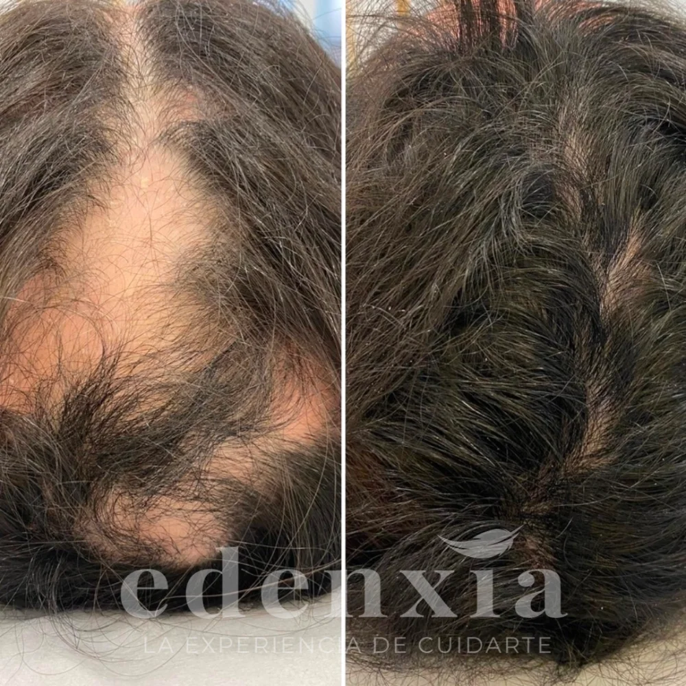 mesoterapia capilar